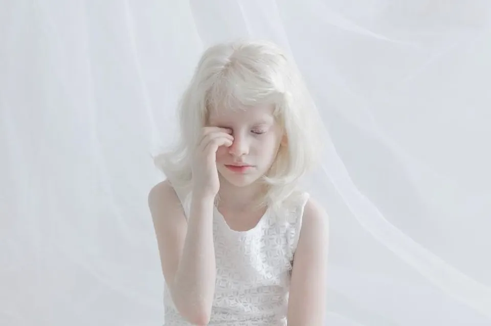 Can Albino People Dye Their Hair