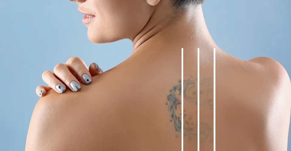Does Tattoo Removal Leave Scars? How to Prevent Scars?