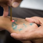 How to Remove Tattoo from Hand