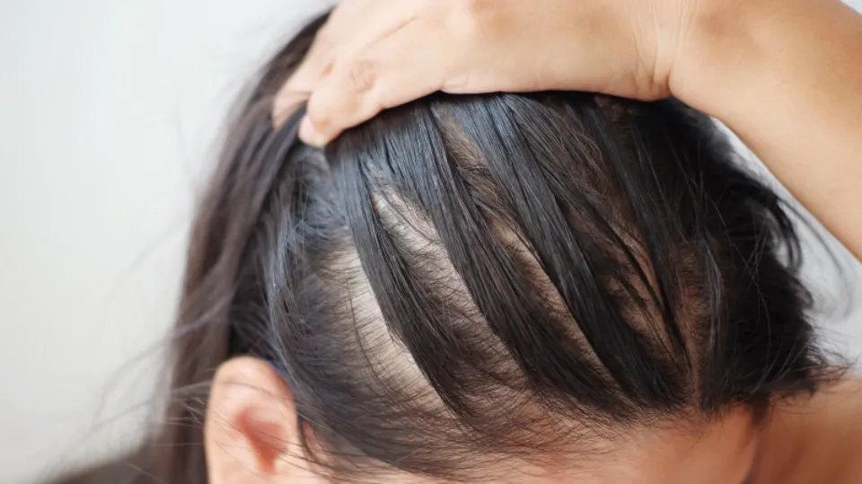 Can Hair Loss Be Reversed