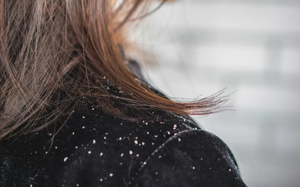 Does Dandruff Cause Hair Loss? Things to Know