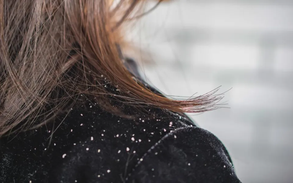 Does Dandruff Cause Hair Loss