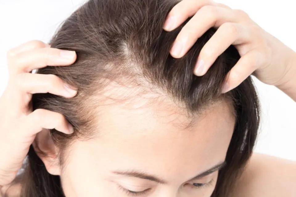 Does Hard Water Cause Hair Loss