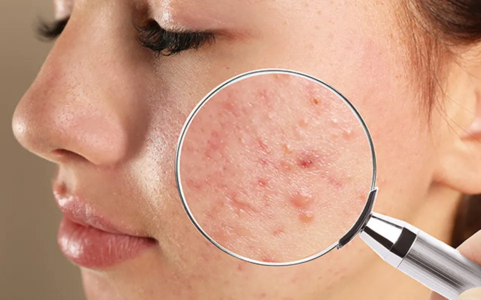 Does Dry Skin Cause Acne
