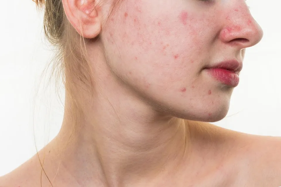 Does Dry Skin Cause Acne