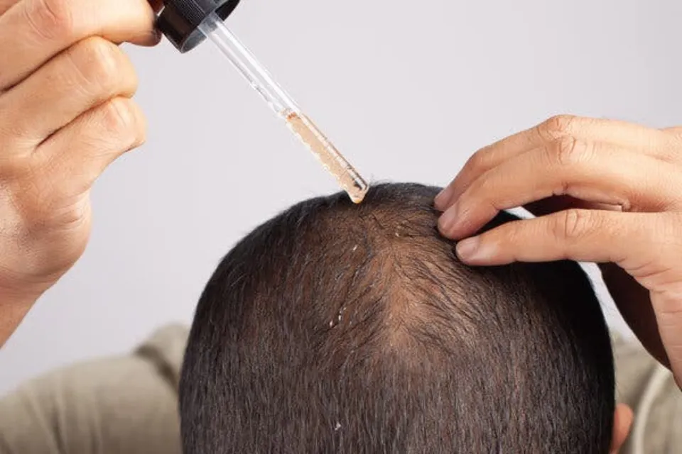 Does Minoxidil Cause Hair Loss