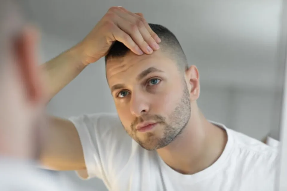 Does Testosterone Cause Hair Loss? Facts to Know