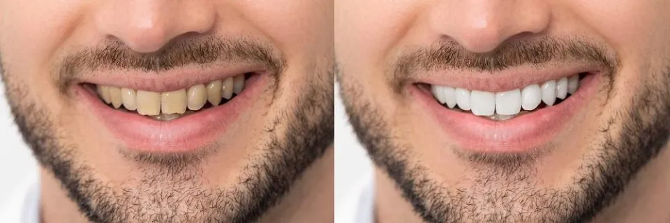 Are Yellow Teeth Stronger Than White Teeth