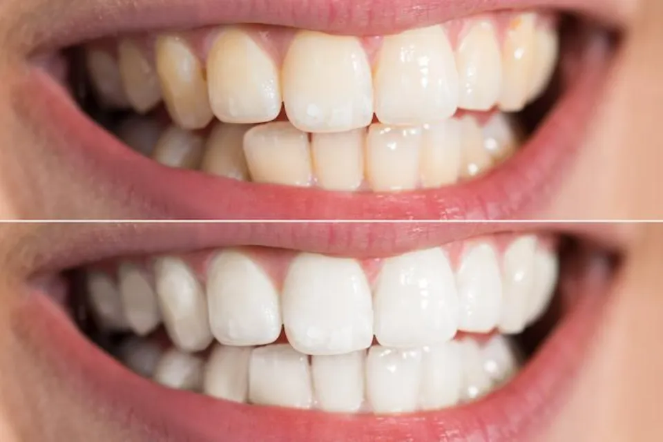 Are Yellow Teeth Stronger Than White Teeth