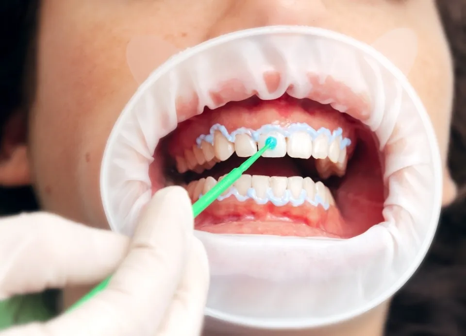 How Long Does It Take to Whiten Teeth