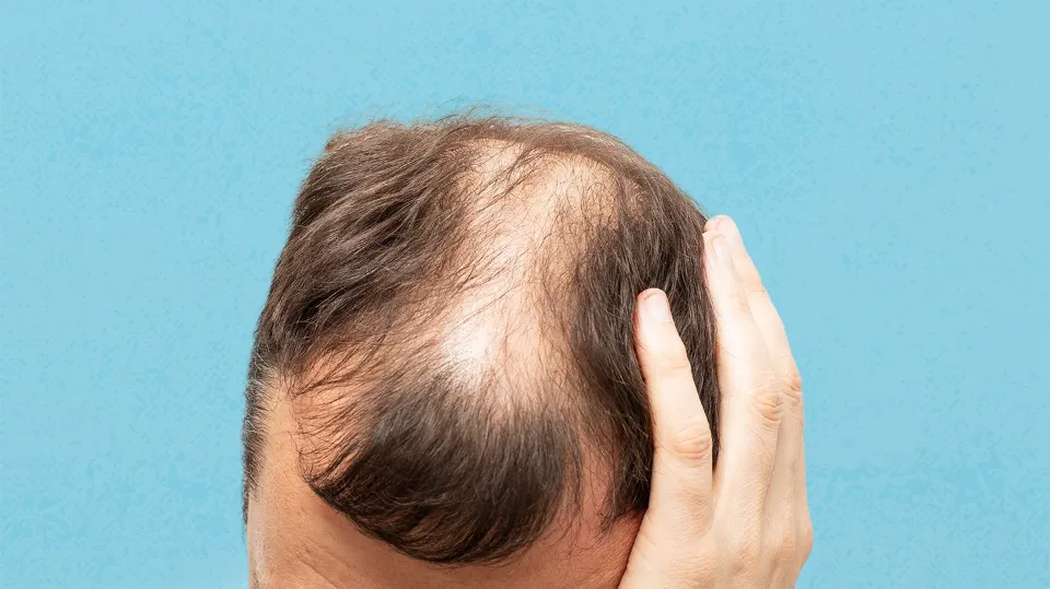 Is Hair Loss Genetic
