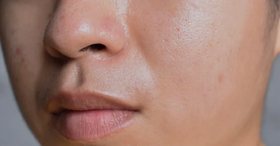 Why is My Skin Oily? 7 Main Causes