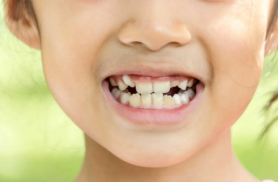 can you whiten kids teeth