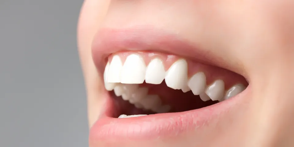 Can You Whiten Bonded Teeth