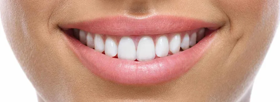 What is Dental Bonding