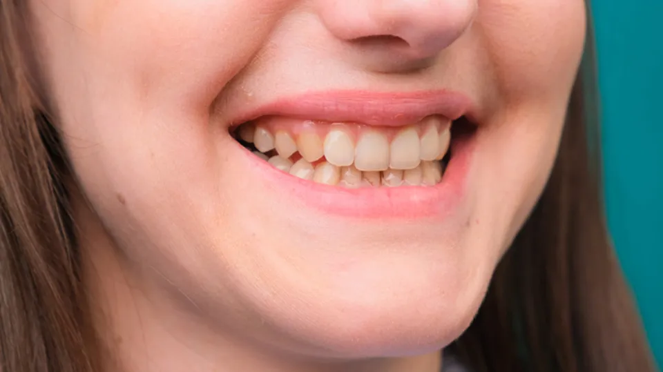 Why Aren’t My Teeth White? Causes & Treatments