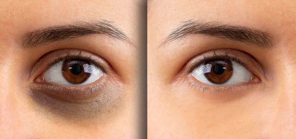 Does Eye Cream Help With Dark Circles? Things to Know